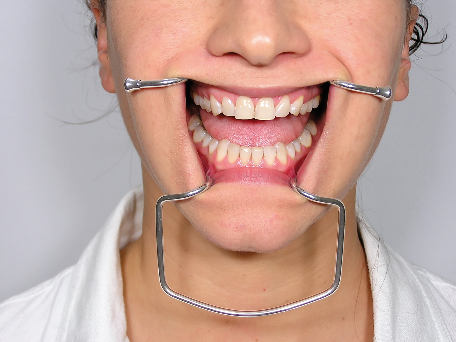 Hands-free cheek & lip retractor CRO Orringer, 3 sizes